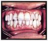 Perodontics and Restoration Dentistry - 
gum disease